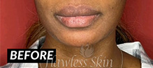 Lip Augmentation Before and After | Flawless Skin