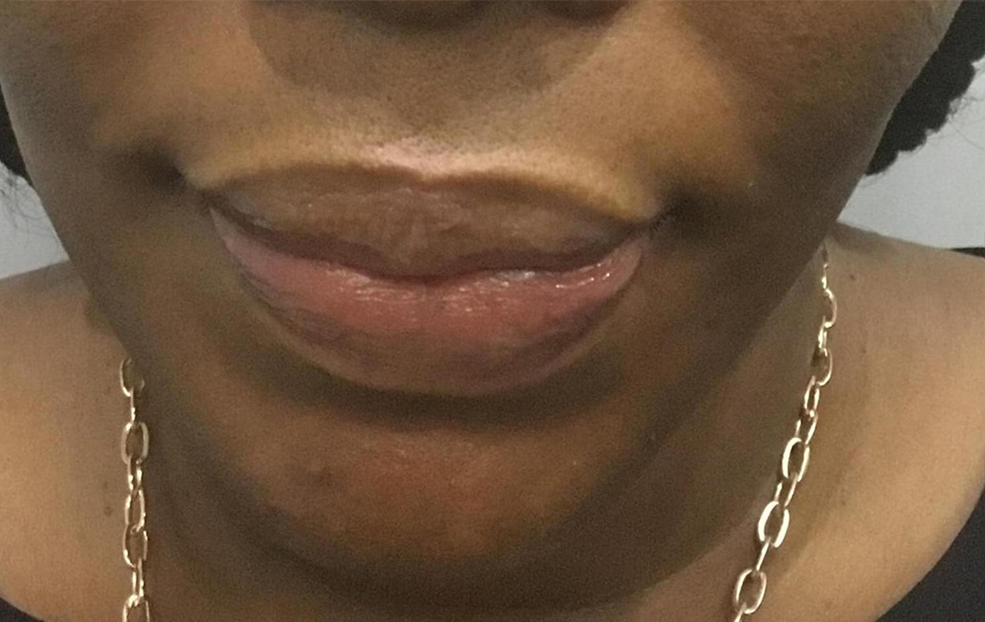 Lip Augmentation Before and After | Flawless Aesthetic Center
