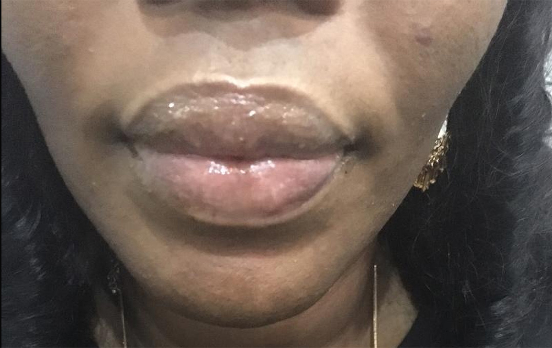 Lip Augmentation Before and After | Flawless Aesthetic Center