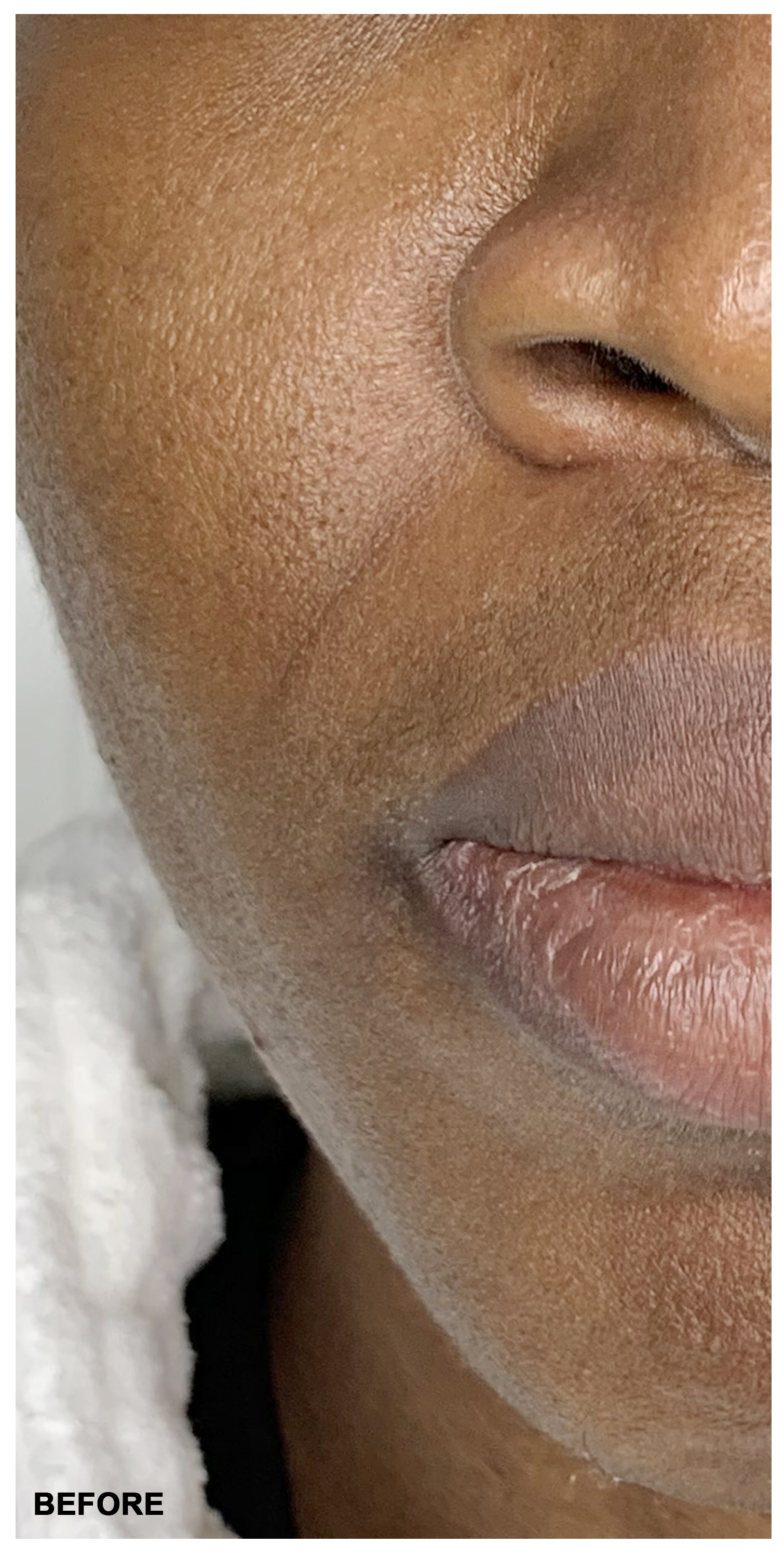 Lip Augmentation Before and After | Flawless Aesthetic Center