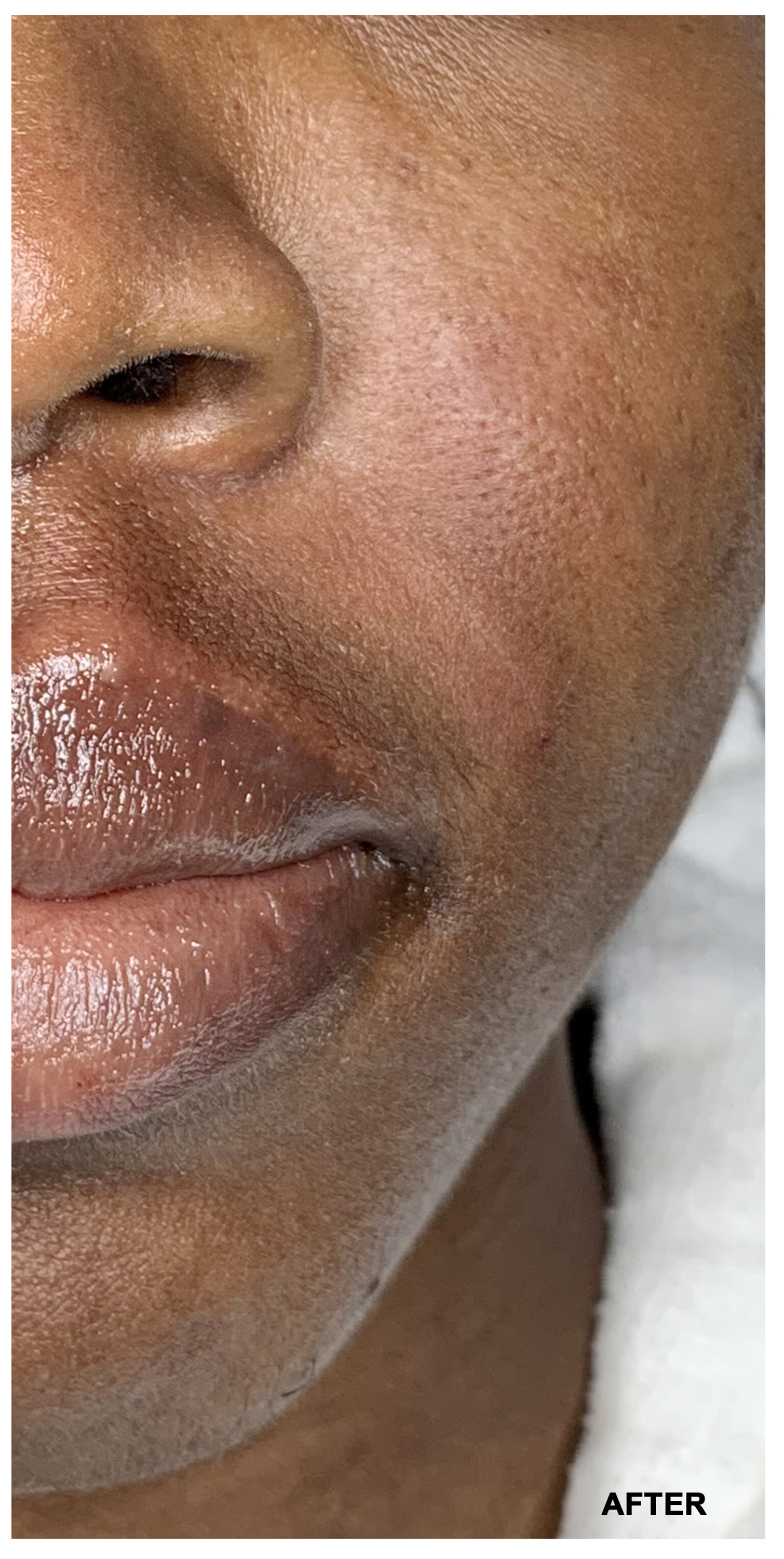 Lip Augmentation Before and After | Flawless Aesthetic Center