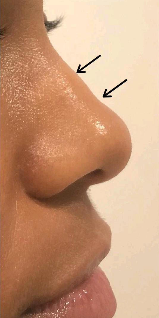 Nose Augmentation Before and After | Flawless Aesthetic Center