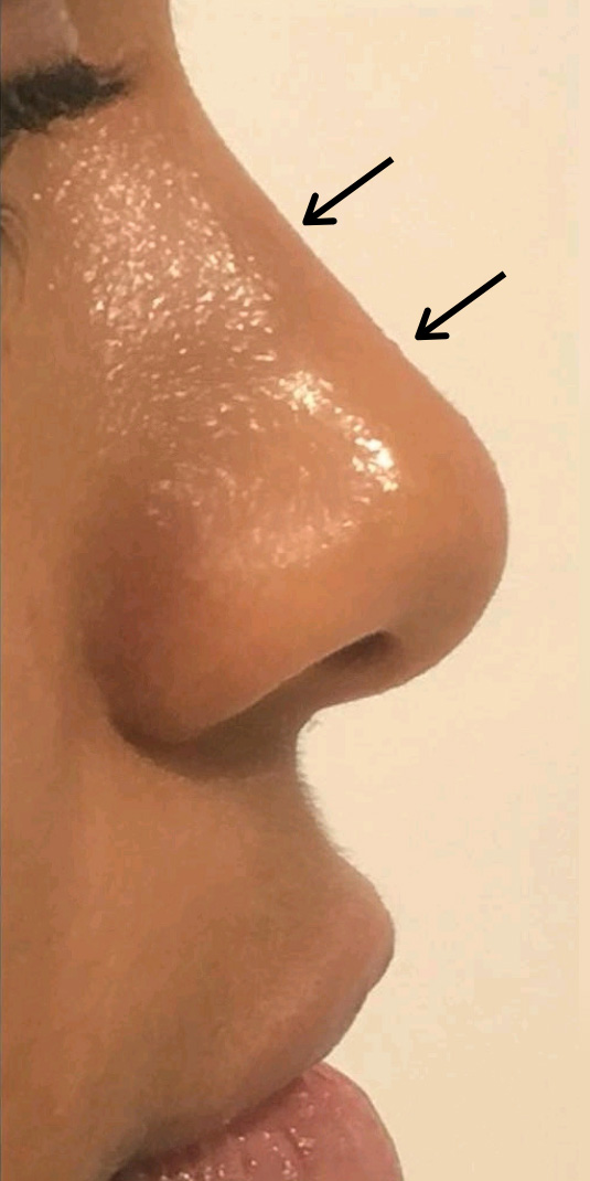 Nose Augmentation Before and After | Flawless Aesthetic Center