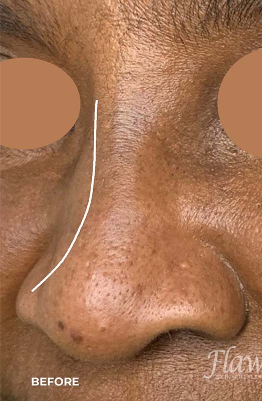 Nose Augmentation Before and After | Flawless Aesthetic Center