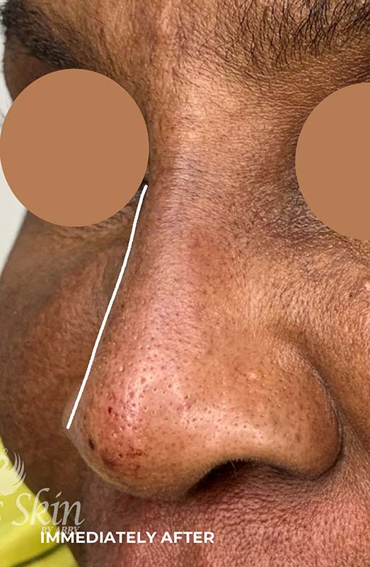 Nose Augmentation Before and After | Flawless Aesthetic Center