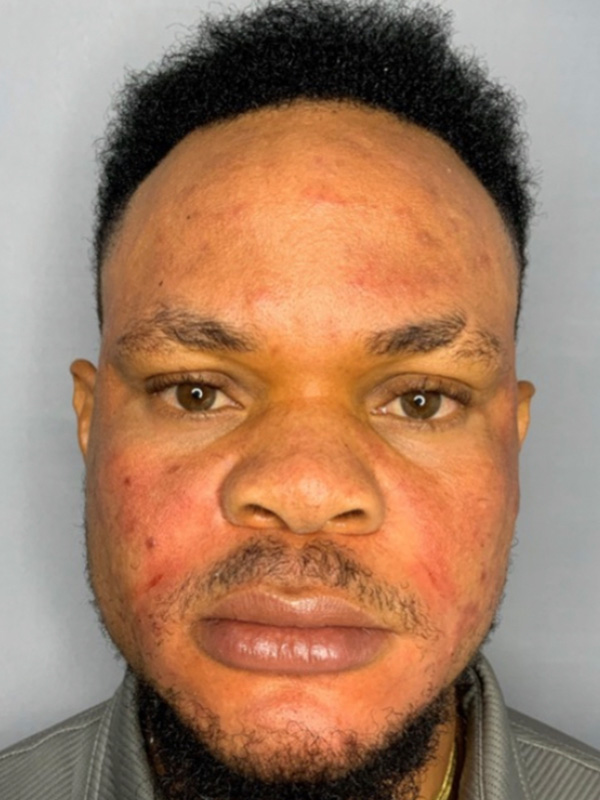 Smile Lines And Nasolabial Fold Fillers Before and After | Flawless Aesthetic Center