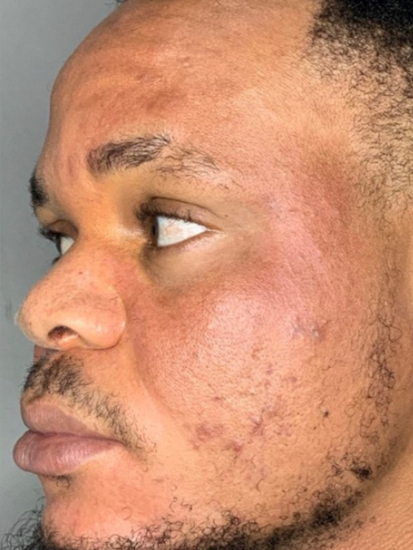 Smile Lines And Nasolabial Fold Fillers Before and After | Flawless Aesthetic Center