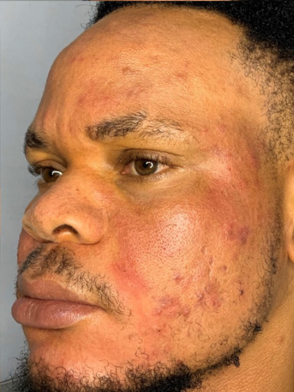 Smile Lines And Nasolabial Fold Fillers Before and After | Flawless Aesthetic Center