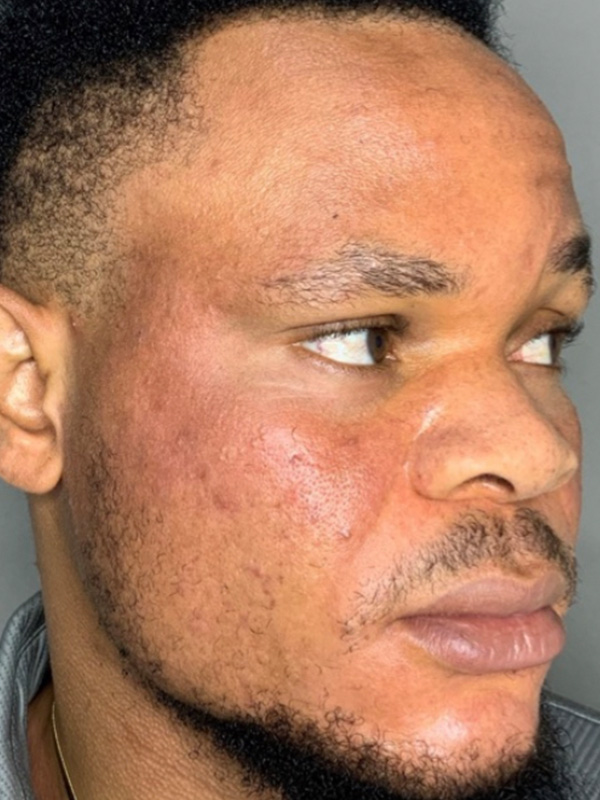 Smile Lines And Nasolabial Fold Fillers Before and After | Flawless Aesthetic Center