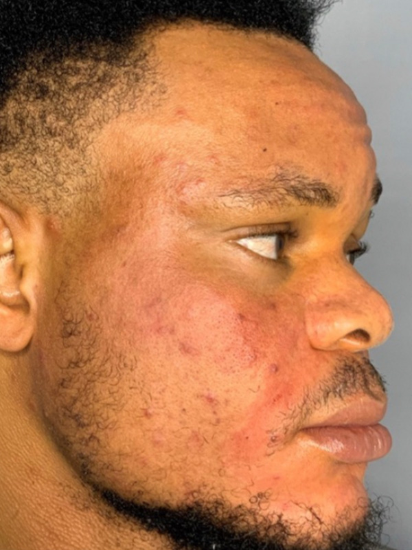 Smile Lines And Nasolabial Fold Fillers Before and After | Flawless Aesthetic Center