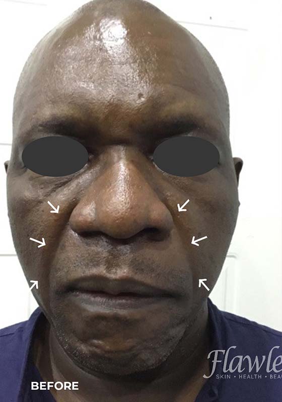 Smile Lines And Nasolabial Fold Fillers Before and After | Flawless Aesthetic Center