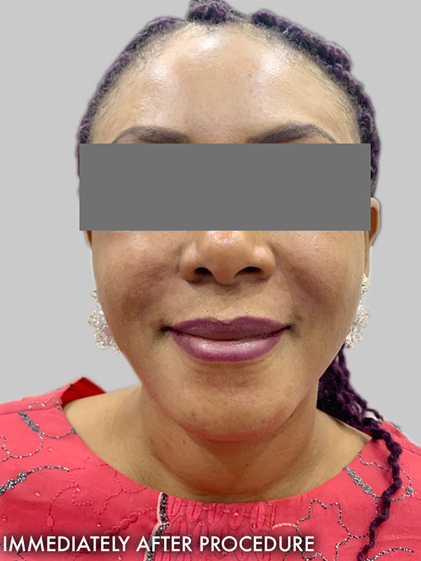 Smile Lines And Nasolabial Fold Fillers Before and After | Flawless Aesthetic Center