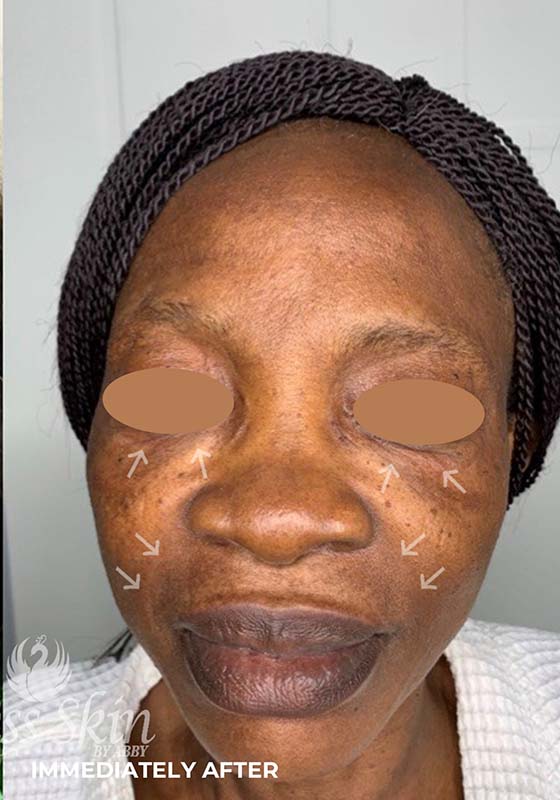 Smile Lines And Nasolabial Fold Fillers Before and After | Flawless Aesthetic Center
