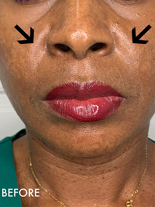 Smile Lines And Nasolabial Fold Fillers Before and After | Flawless Aesthetic Center