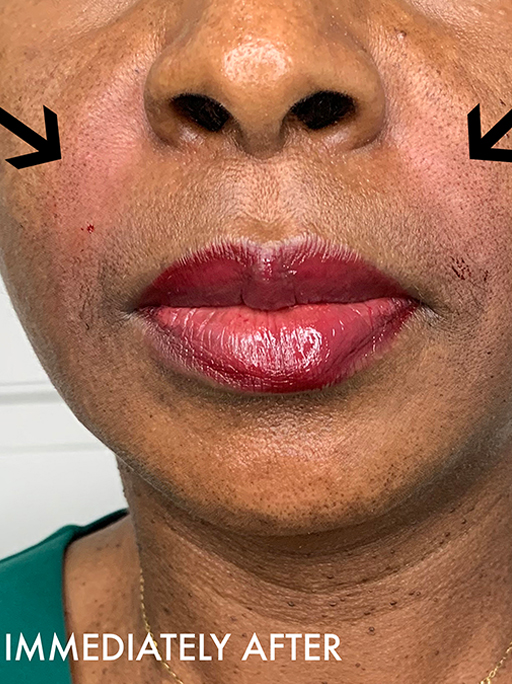 Smile Lines And Nasolabial Fold Fillers Before and After | Flawless Aesthetic Center