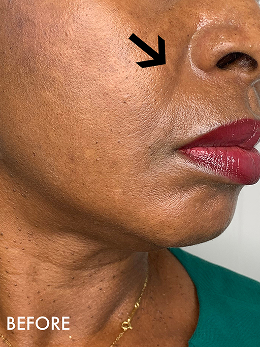 Smile Lines And Nasolabial Fold Fillers Before and After | Flawless Aesthetic Center