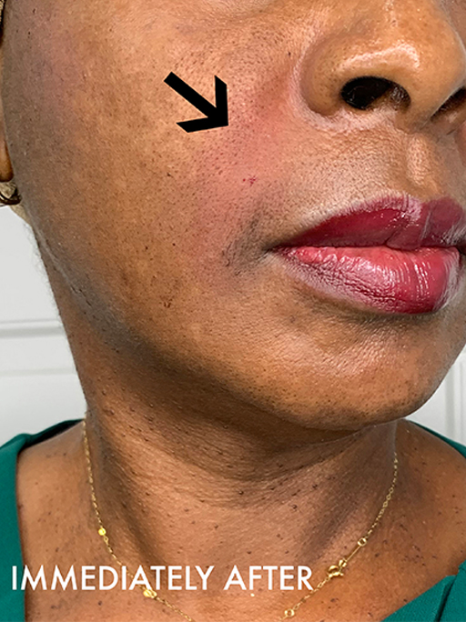 Smile Lines And Nasolabial Fold Fillers Before and After | Flawless Aesthetic Center