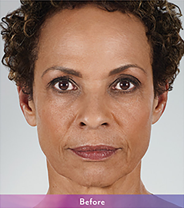 Smile Lines And Nasolabial Fold Fillers Before and After | Flawless Aesthetic Center