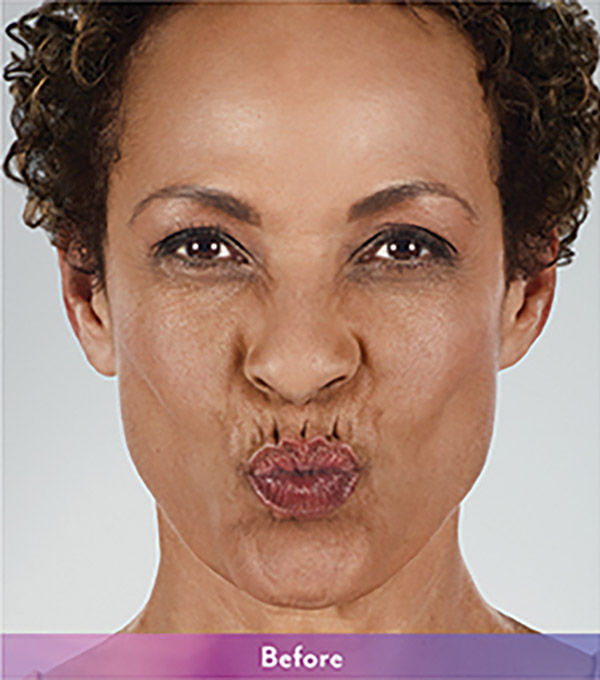 Smile Lines And Nasolabial Fold Fillers Before and After | Flawless Aesthetic Center