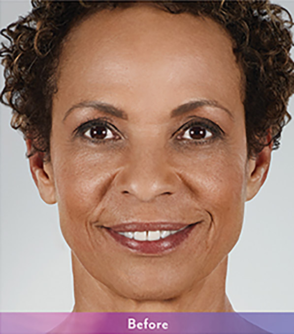 Smile Lines And Nasolabial Fold Fillers Before and After | Flawless Aesthetic Center