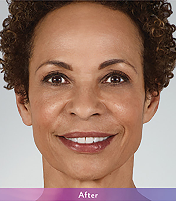 Smile Lines And Nasolabial Fold Fillers Before and After | Flawless Aesthetic Center