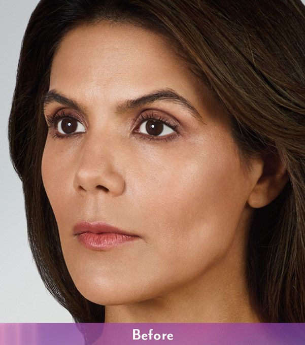 Smile Lines And Nasolabial Fold Fillers Before and After | Flawless Aesthetic Center