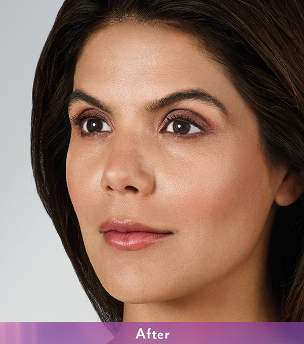 Smile Lines And Nasolabial Fold Fillers Before and After | Flawless Aesthetic Center