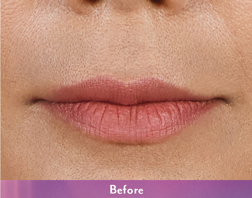 Smile Lines And Nasolabial Fold Fillers Before and After | Flawless Aesthetic Center