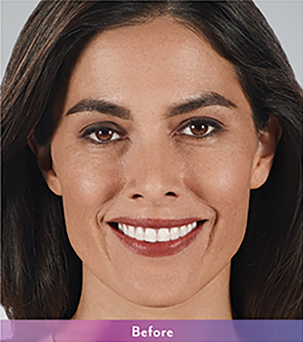 Smile Lines And Nasolabial Fold Fillers Before and After | Flawless Aesthetic Center