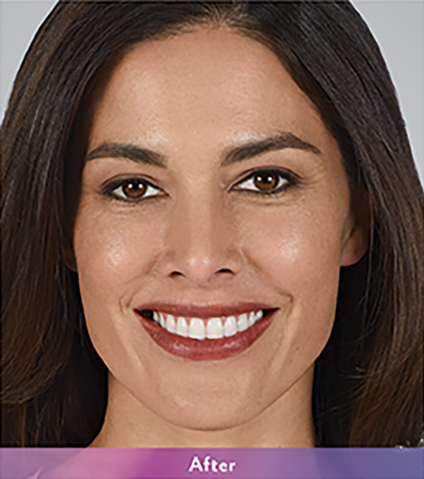 Smile Lines And Nasolabial Fold Fillers Before and After | Flawless Aesthetic Center