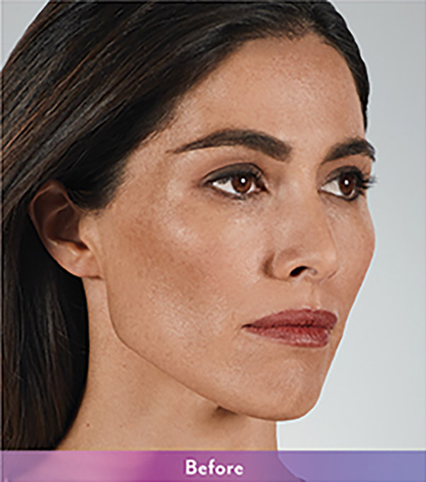 Smile Lines And Nasolabial Fold Fillers Before and After | Flawless Aesthetic Center