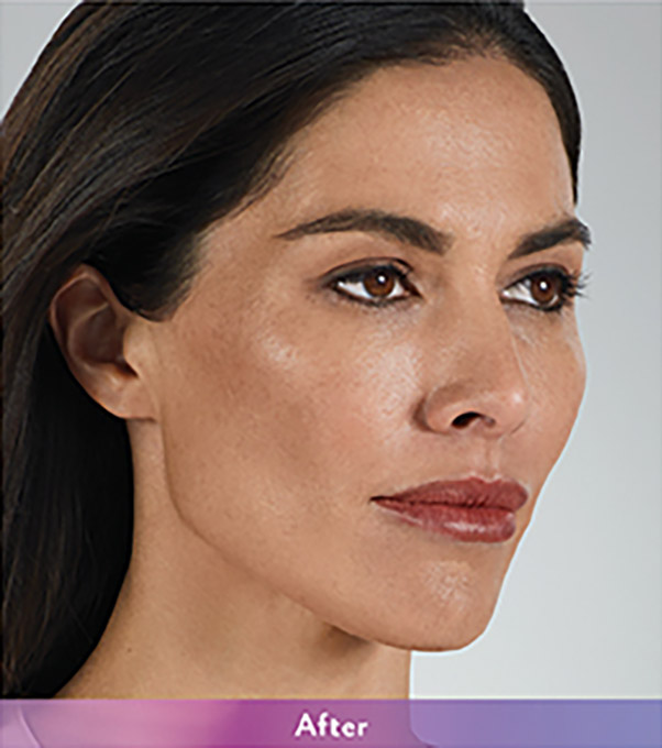 Smile Lines And Nasolabial Fold Fillers Before and After | Flawless Aesthetic Center