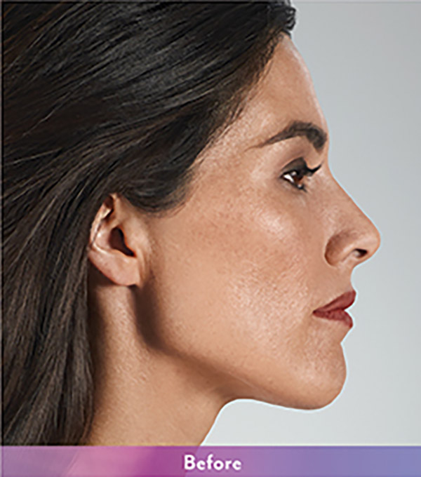 Smile Lines And Nasolabial Fold Fillers Before and After | Flawless Aesthetic Center