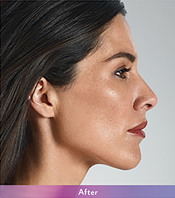 Smile Lines And Nasolabial Fold Fillers Before and After | Flawless Aesthetic Center