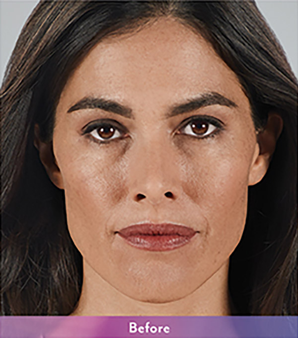 Smile Lines And Nasolabial Fold Fillers Before and After | Flawless Aesthetic Center