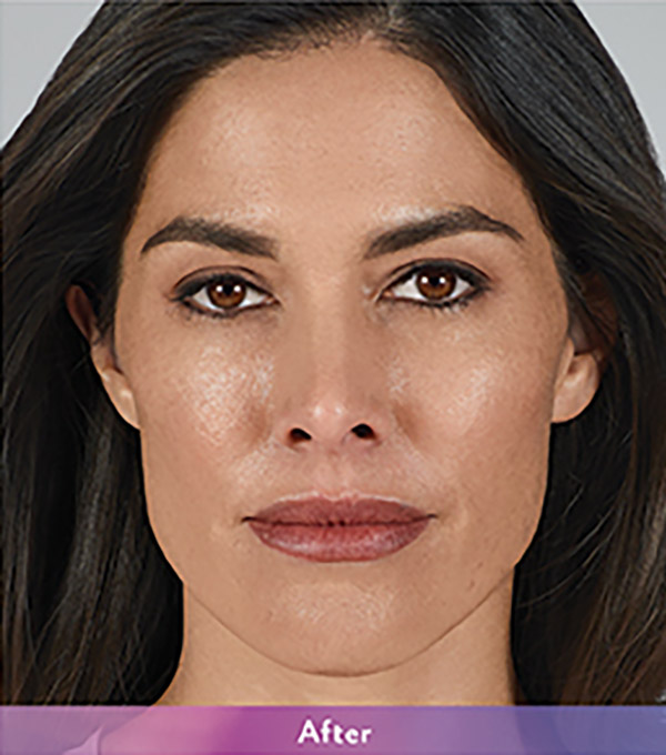 Smile Lines And Nasolabial Fold Fillers Before and After | Flawless Aesthetic Center