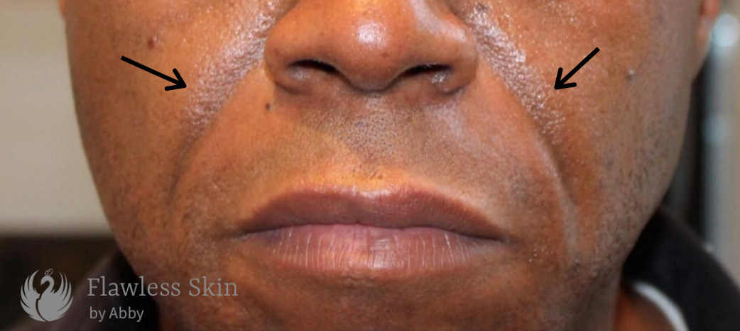 Smile Lines And Nasolabial Fold Fillers Before and After | Flawless Aesthetic Center