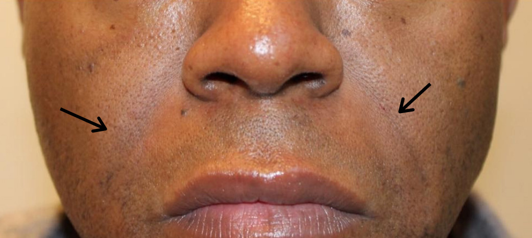 Smile Lines And Nasolabial Fold Fillers Before and After | Flawless Aesthetic Center