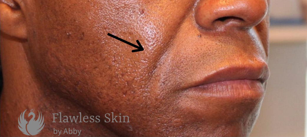Smile Lines And Nasolabial Fold Fillers Before and After | Flawless Aesthetic Center