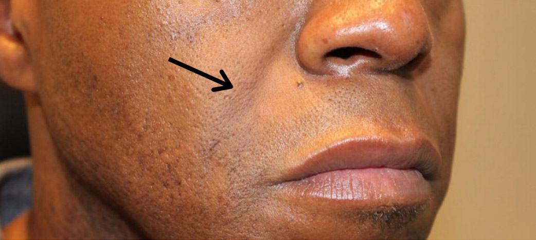 Smile Lines And Nasolabial Fold Fillers Before and After | Flawless Aesthetic Center