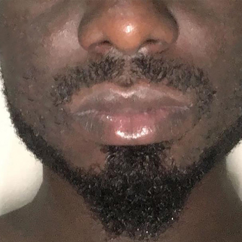 Smile Lines And Nasolabial Fold Fillers Before and After | Flawless Aesthetic Center