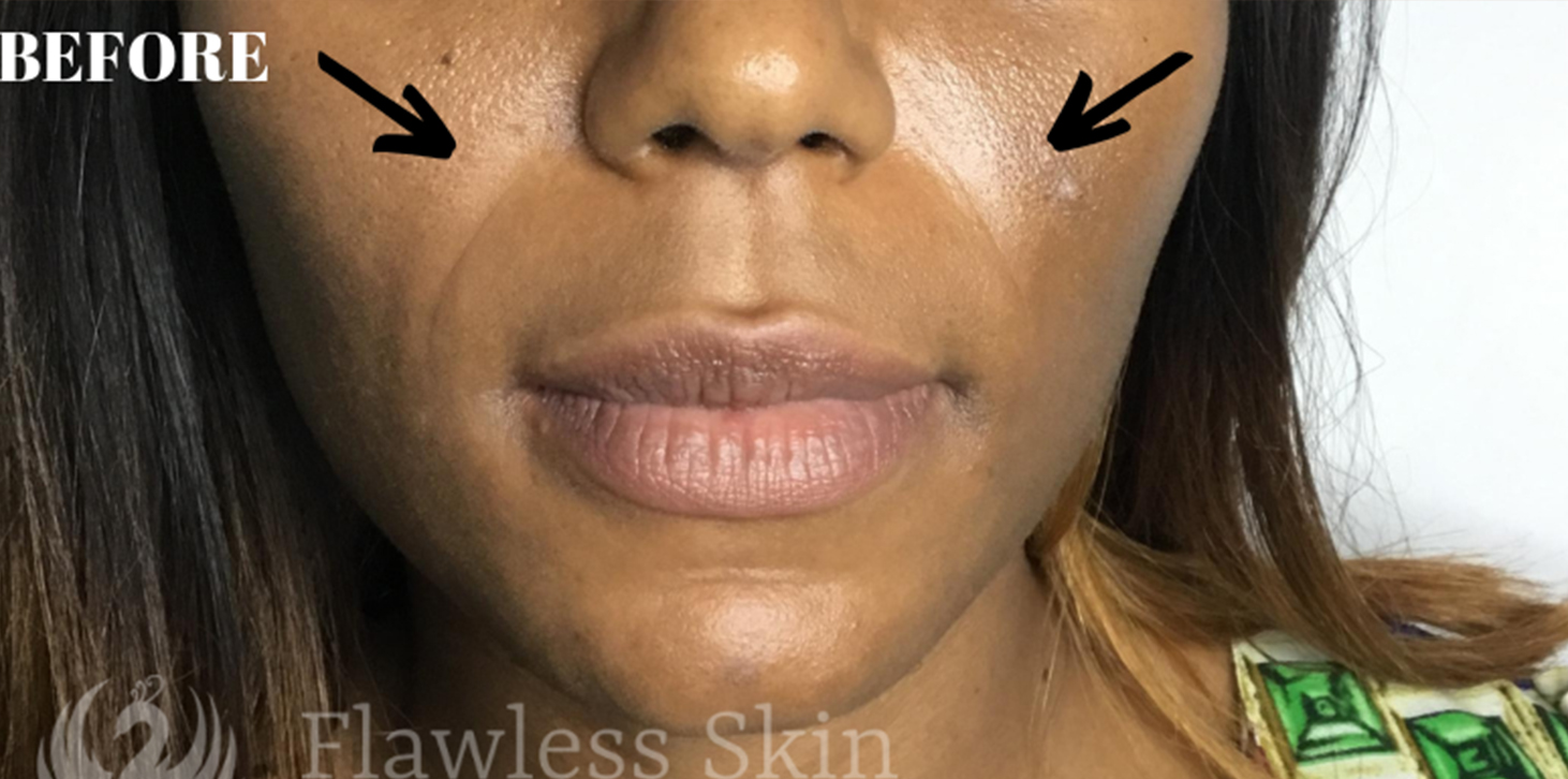 Smile Lines And Nasolabial Fold Fillers Before and After | Flawless Skin