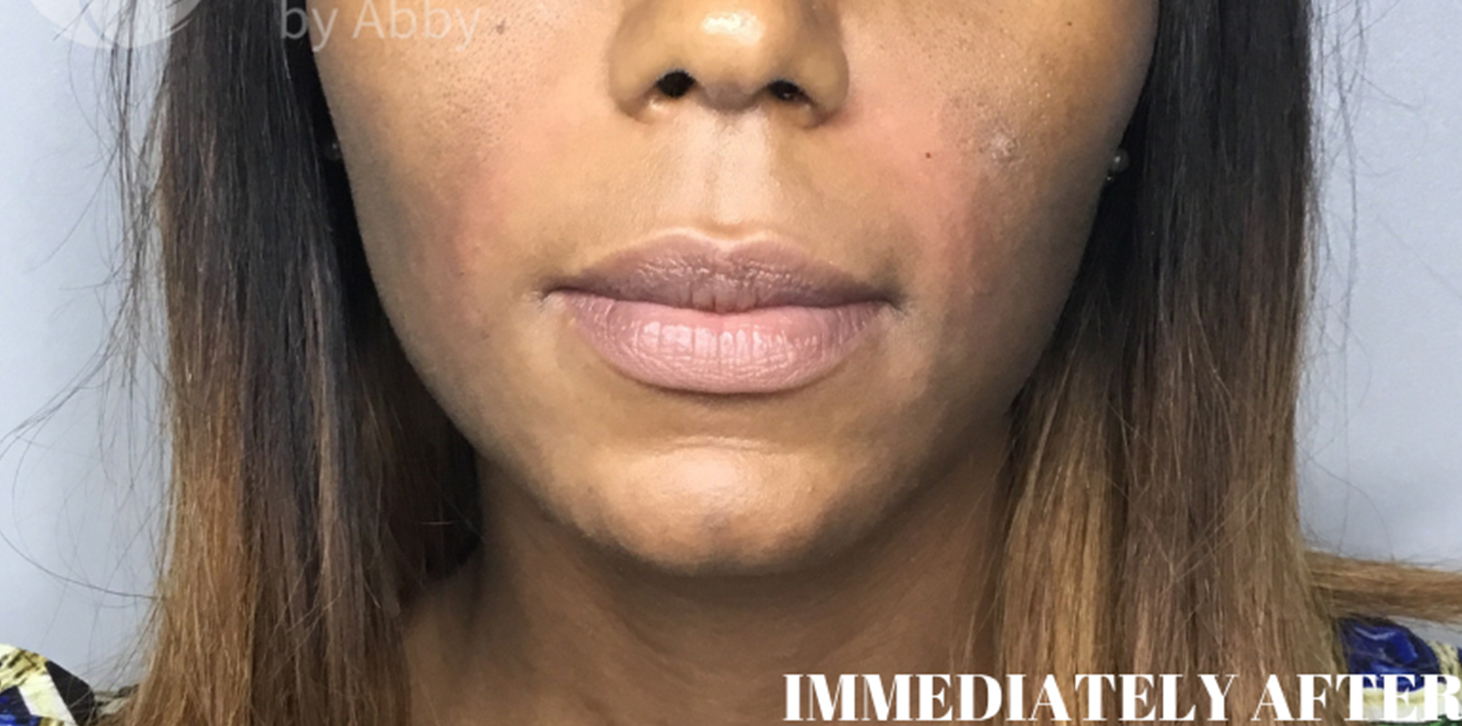 Smile Lines And Nasolabial Fold Fillers Before and After | Flawless Aesthetic Center