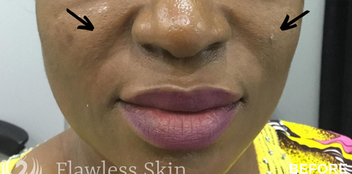 Smile Lines And Nasolabial Fold Fillers Before and After | Flawless Aesthetic Center