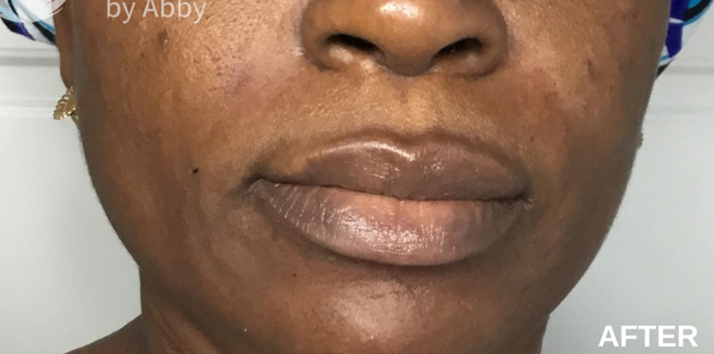 Smile Lines And Nasolabial Fold Fillers Before and After | Flawless Aesthetic Center