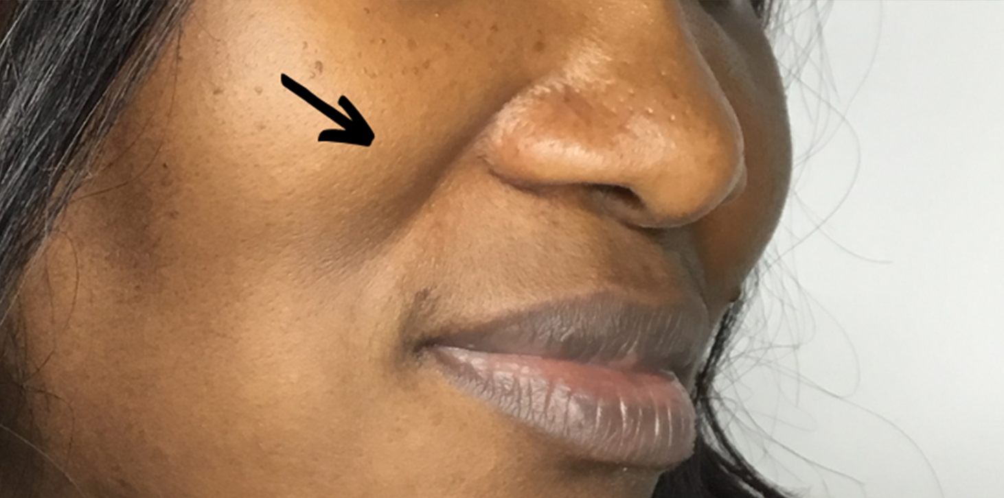 Smile Lines And Nasolabial Fold Fillers Before and After | Flawless Aesthetic Center