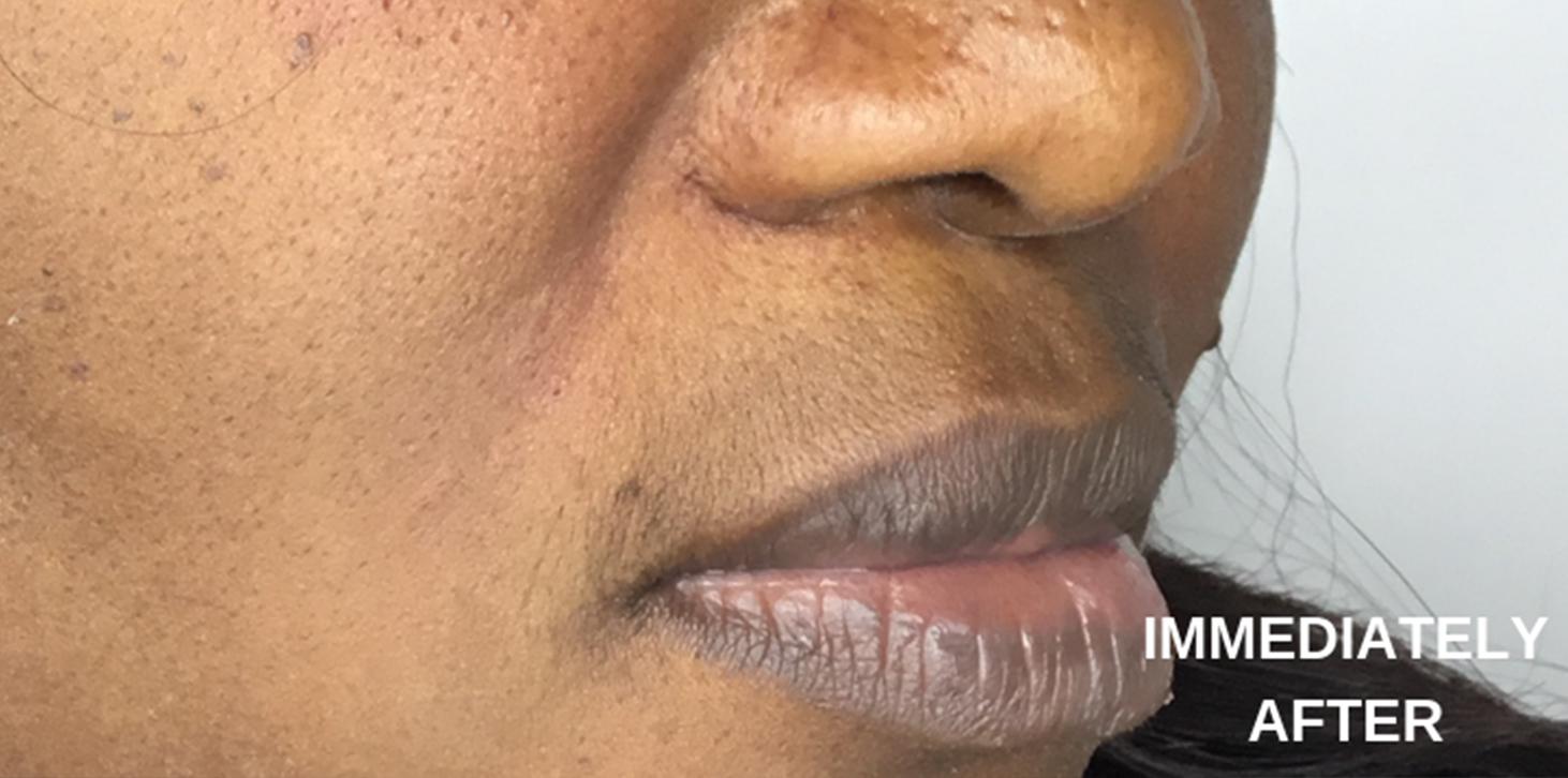 Smile Lines And Nasolabial Fold Fillers Before and After | Flawless Aesthetic Center
