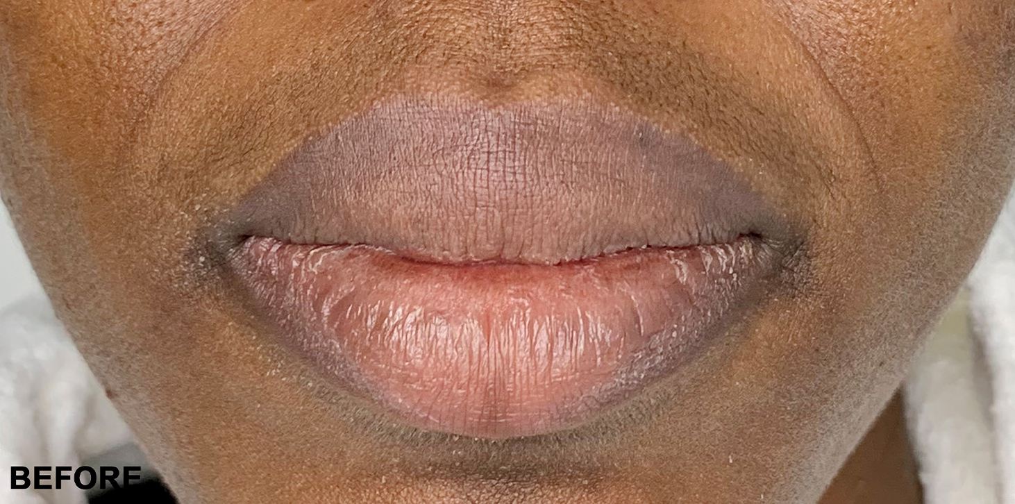 Smile Lines And Nasolabial Fold Fillers Before and After | Flawless Aesthetic Center