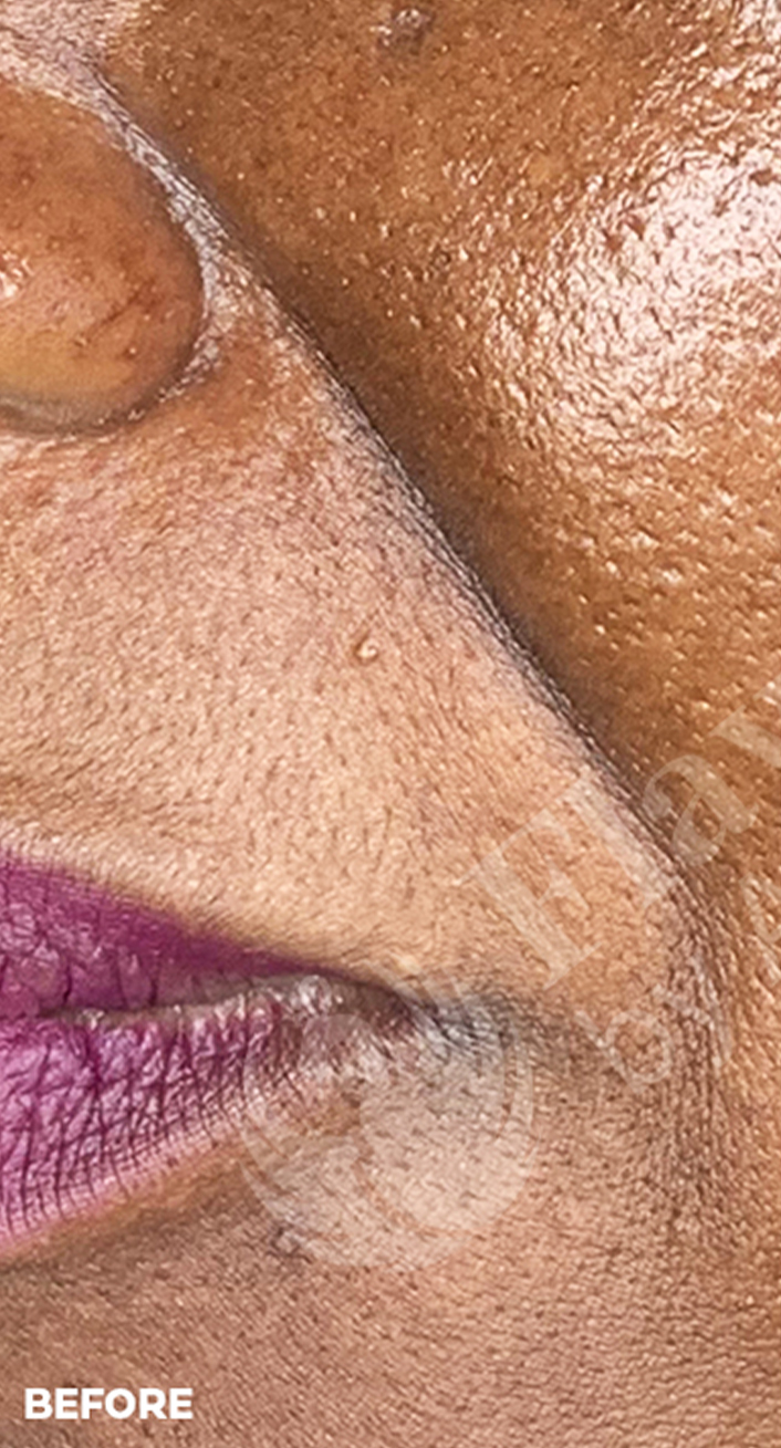 Smile Lines And Nasolabial Fold Fillers Before and After | Flawless Aesthetic Center