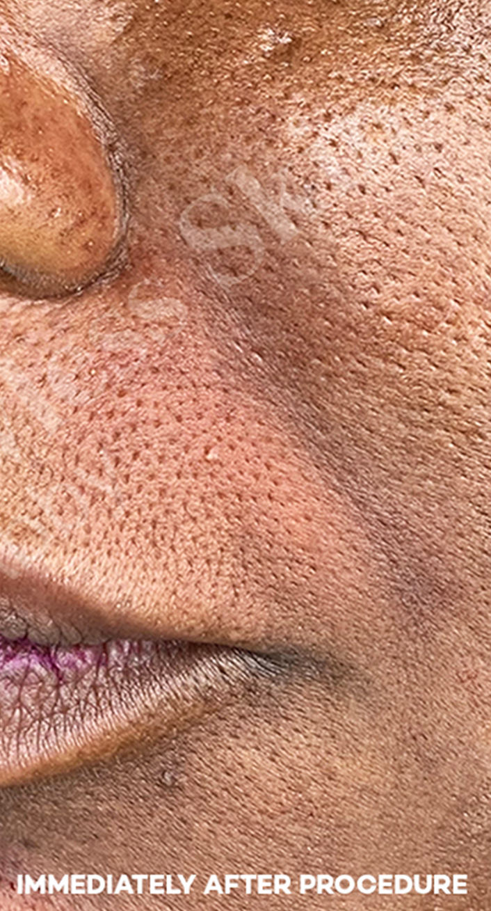 Smile Lines And Nasolabial Fold Fillers Before and After | Flawless Aesthetic Center